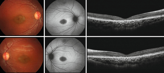 Macular dystrophy treatment in India